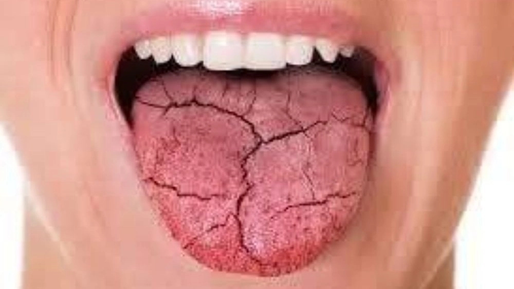 خشکی دهان در افراد مبتلا به دیابت